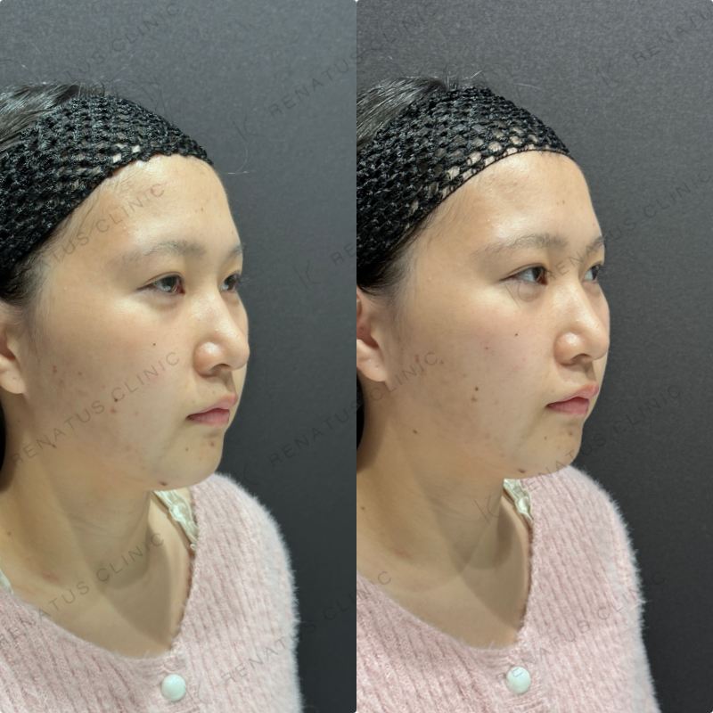 頬ヒアルロン酸ダイヤモンドフィール症例写真