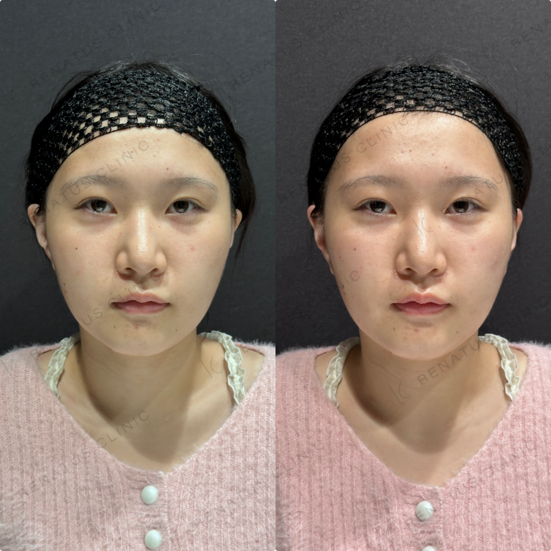 頬ヒアルロン酸ダイヤモンドフィール症例写真