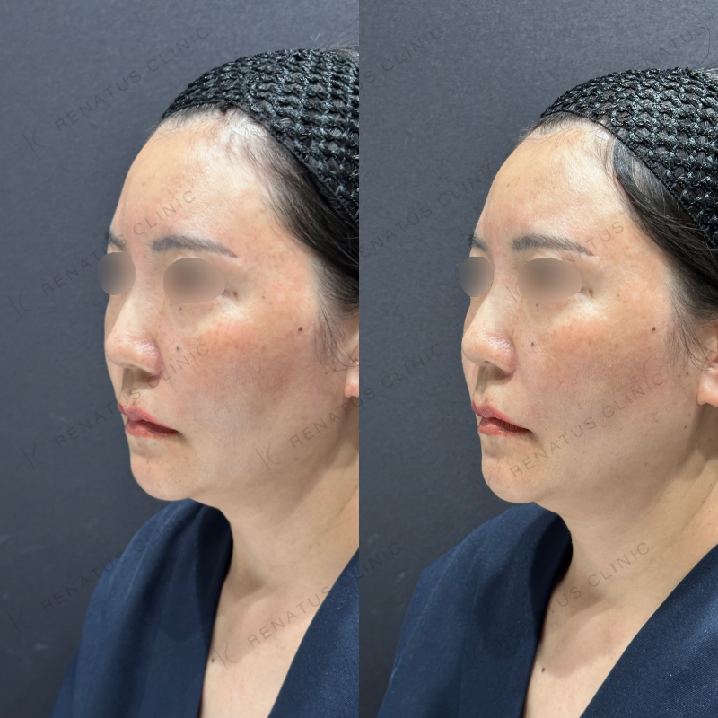 頬ヒアルロン酸ボライト症例写真