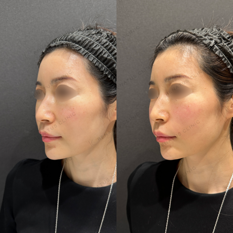 頬ヒアルロン酸ボライト症例写真