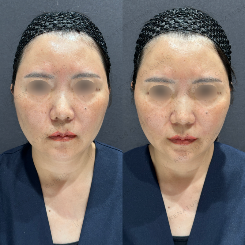 頬ヒアルロン酸ボライト症例写真