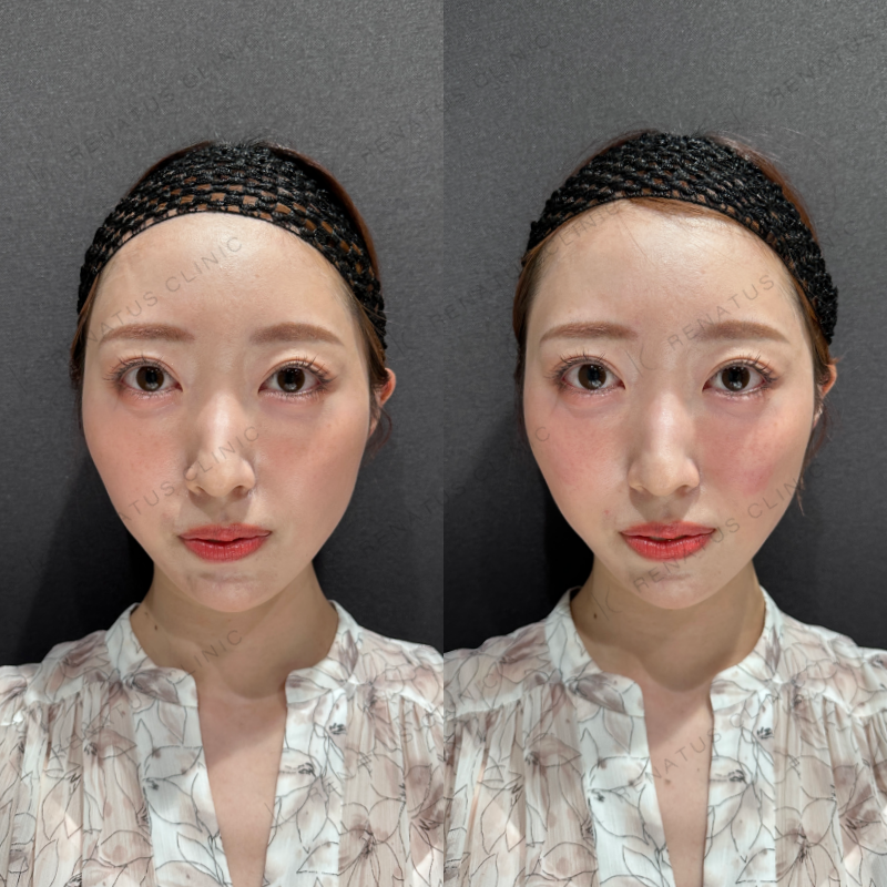 頬ヒアルロン酸ボリフト症例写真