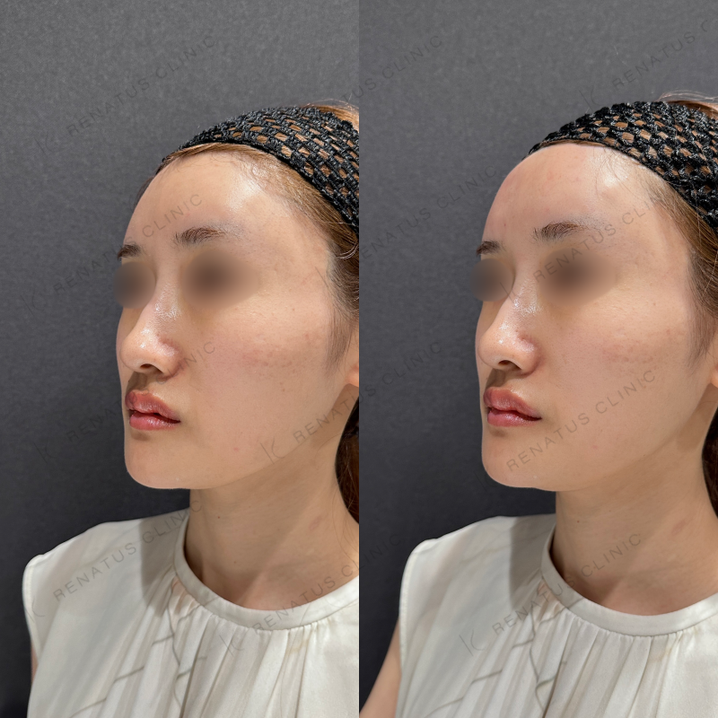 額ヒアルロン酸ボリューマ症例写真