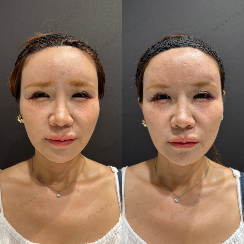 額ヒアルロン酸ボリューマ症例写真
