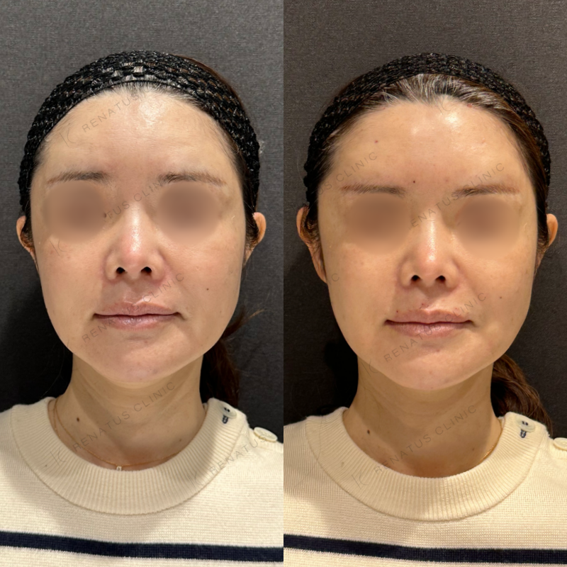額ヒアルロン酸ボリューマ症例写真