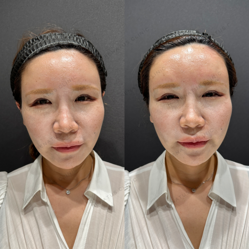 額ヒアルロン酸ボリューマ症例写真
