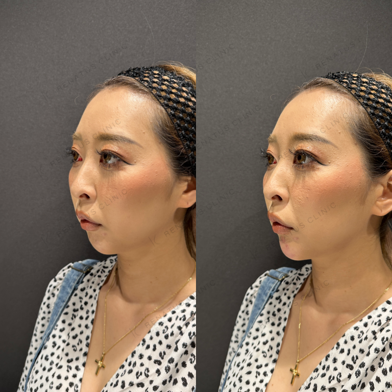 顎ヒアルロン酸ボラックス症例写真