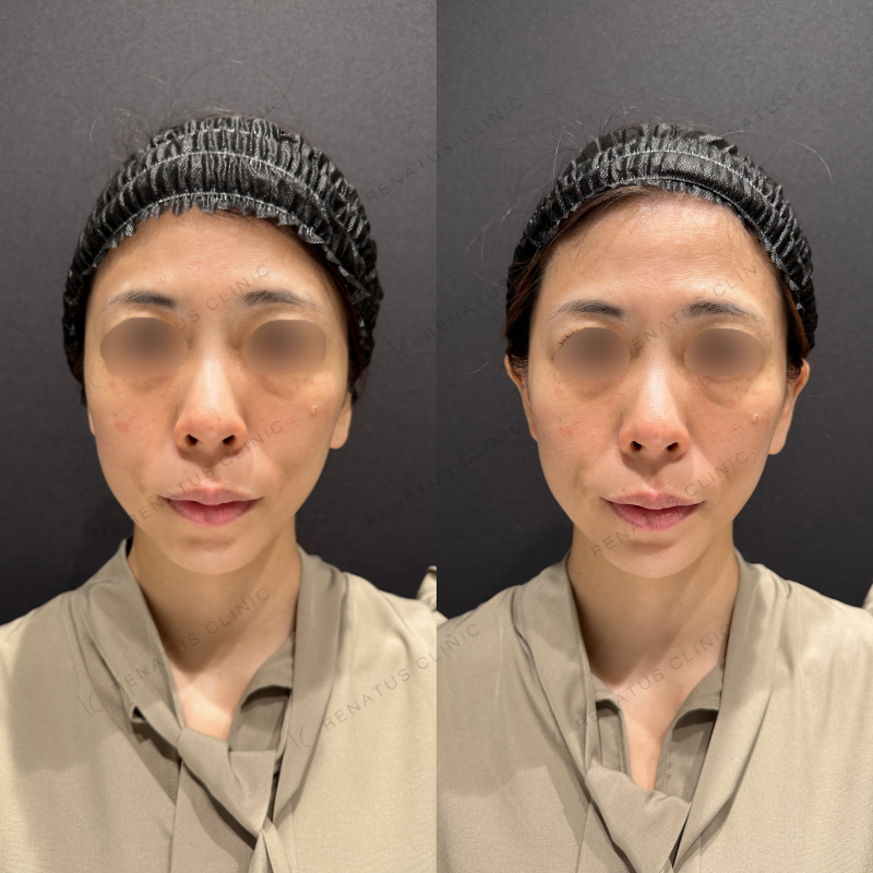 顎ヒアルロン酸ボラックス症例写真