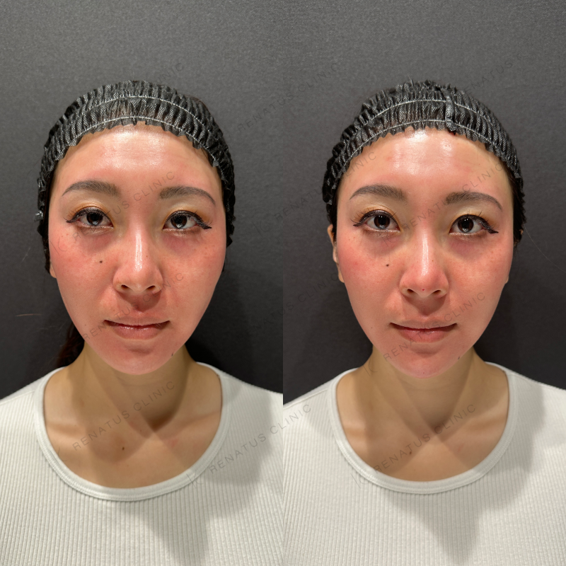 鼻中隔ヒアルロン酸ボラックス症例写真