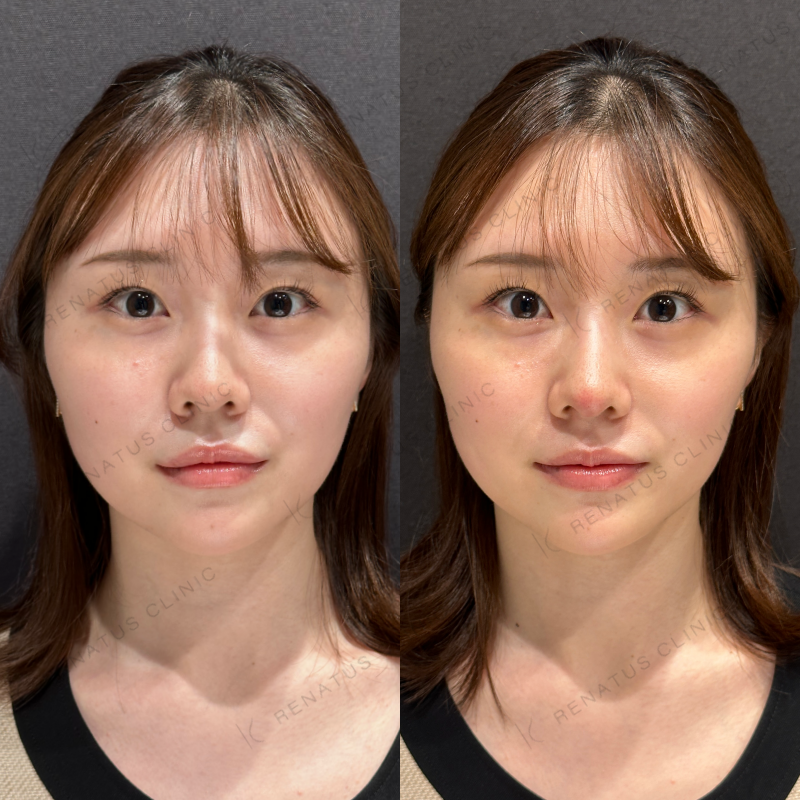 鼻ヒアルロン酸ボラックス症例写真