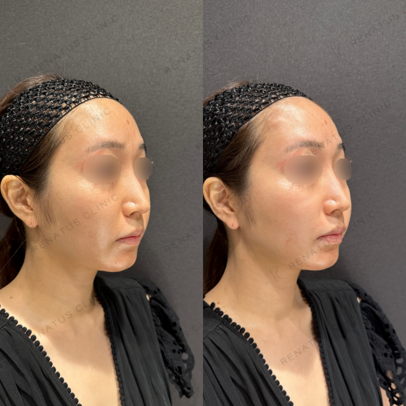 鼻翼基部ヒアルロン酸ボリフト症例写真