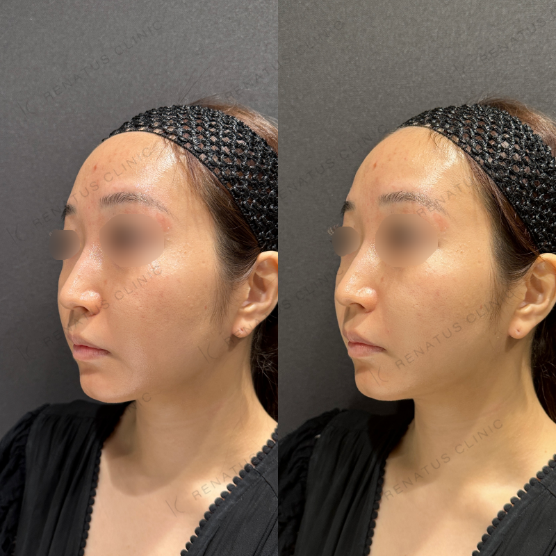 鼻翼基部ヒアルロン酸ボリフト症例写真