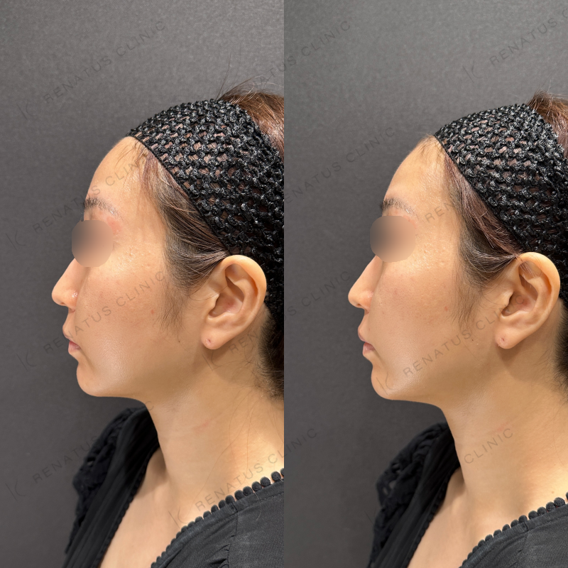 鼻翼基部ヒアルロン酸ボリフト症例写真