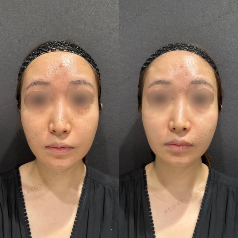 鼻翼基部ヒアルロン酸ボリフト症例写真
