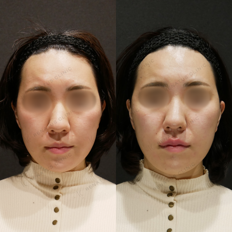 唇ヒアルロン酸ボルベラ症例写真