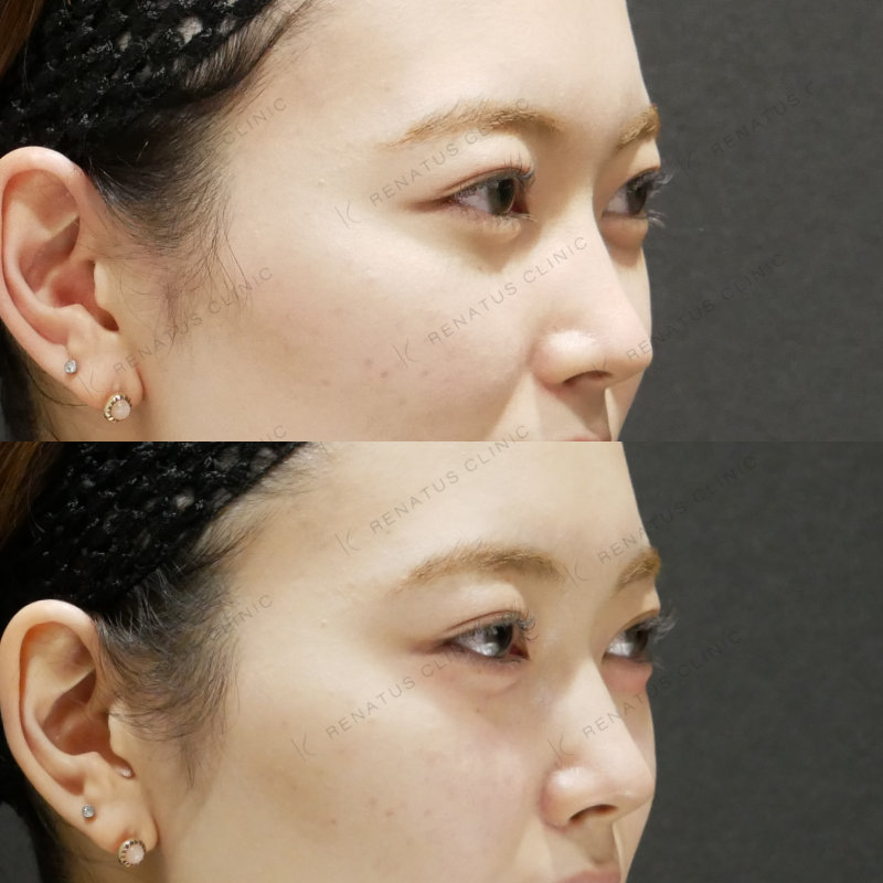 涙袋ヒアルロン酸ボルベラ症例写真