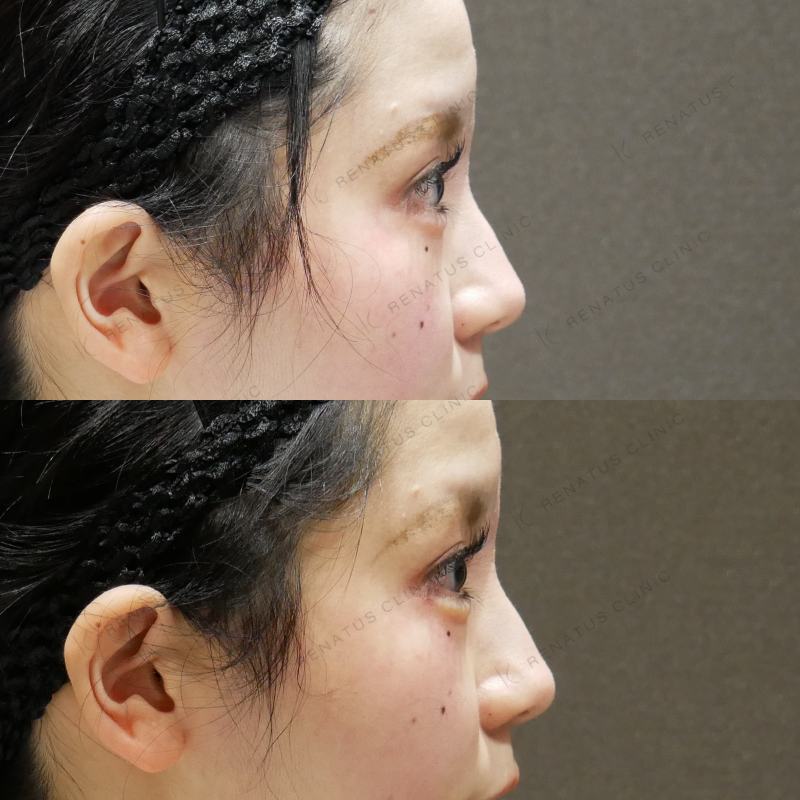 涙袋ヒアルロン酸ボルベラ症例写真