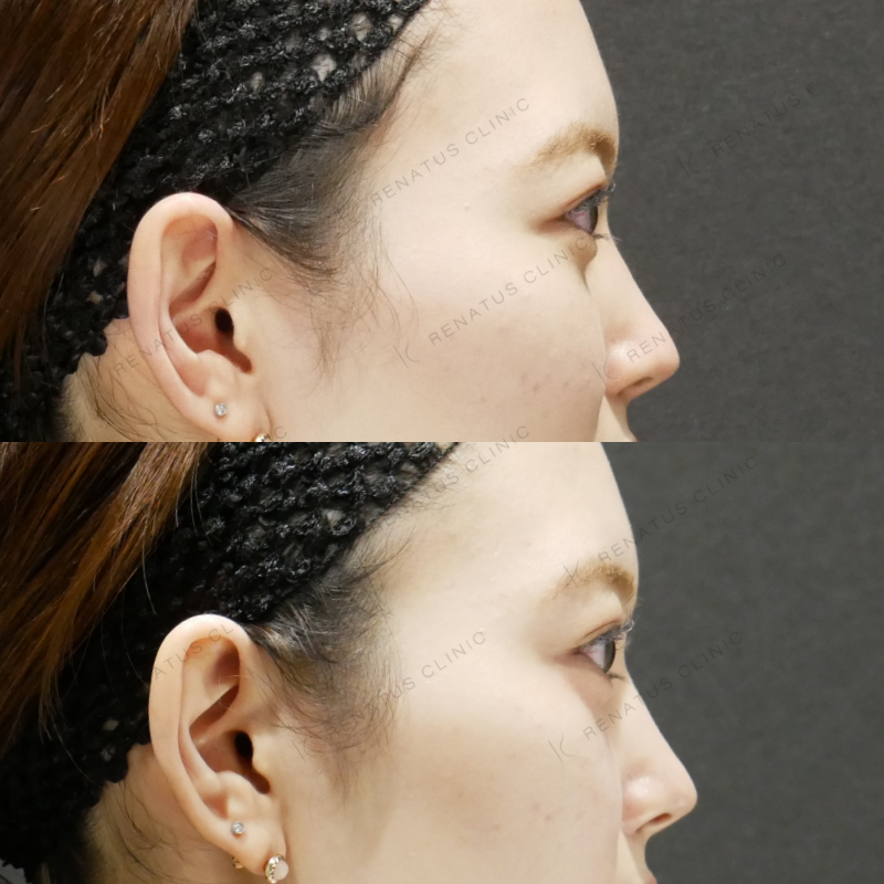 涙袋ヒアルロン酸ボルベラ症例写真