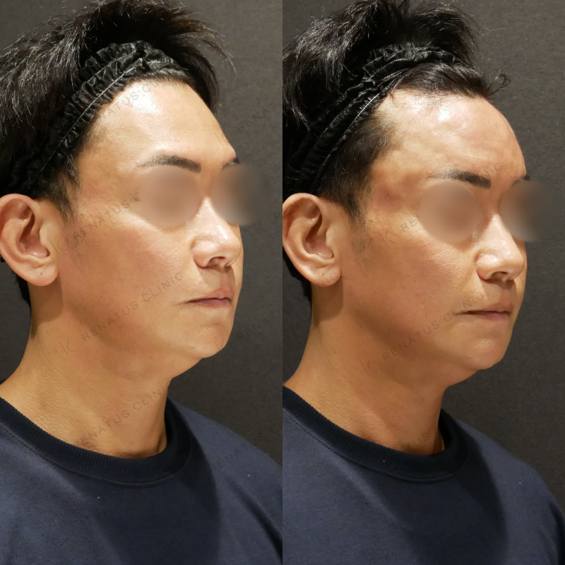 額ヒアルロン酸ボリューマ症例写真