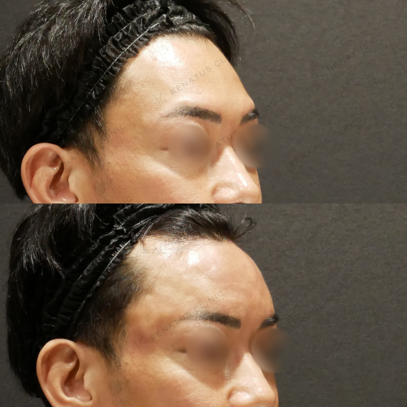 額ヒアルロン酸ボリューマ症例写真