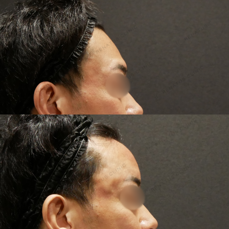 額ヒアルロン酸ボリューマ症例写真