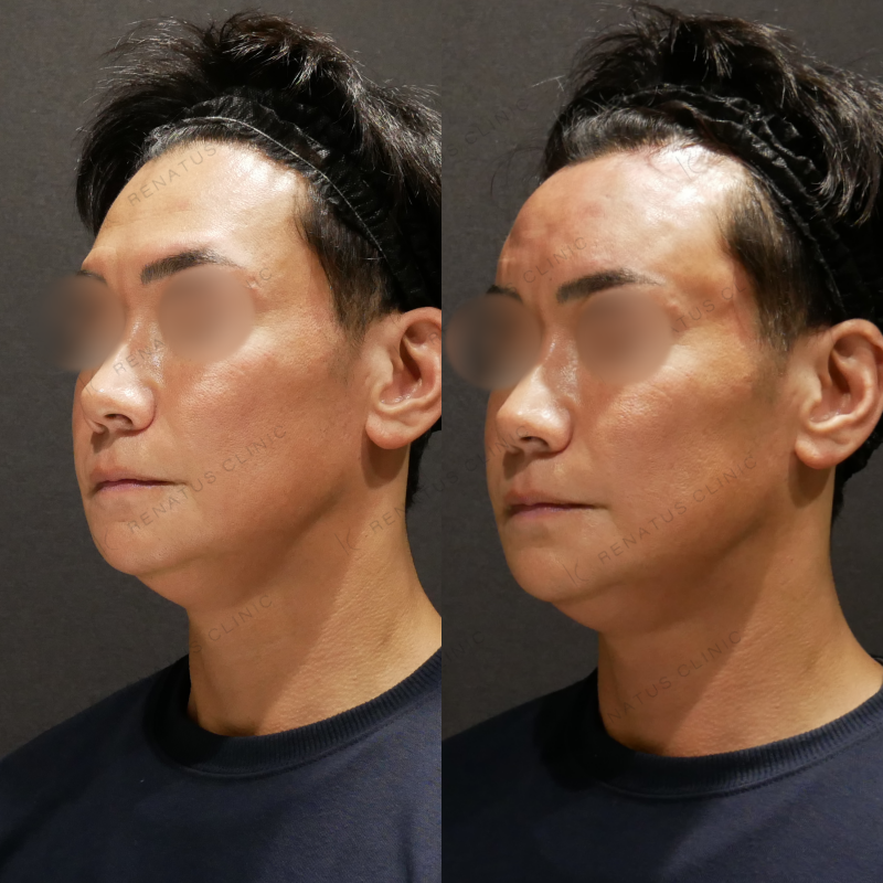 額ヒアルロン酸ボリューマ症例写真