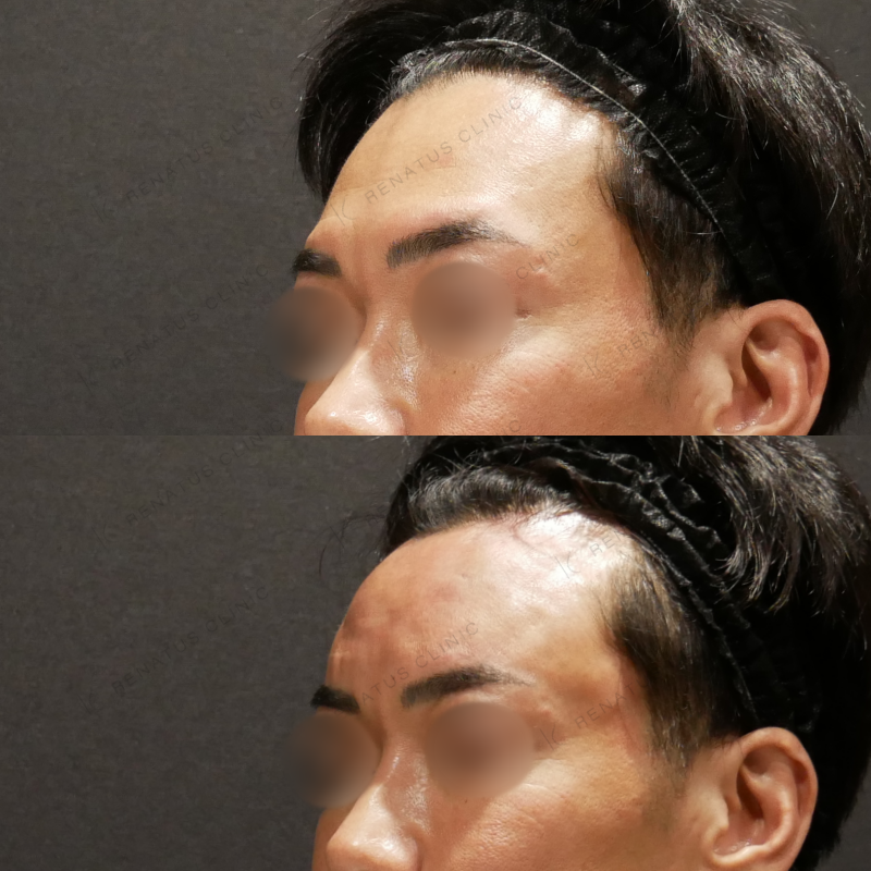 額ヒアルロン酸ボリューマ症例写真