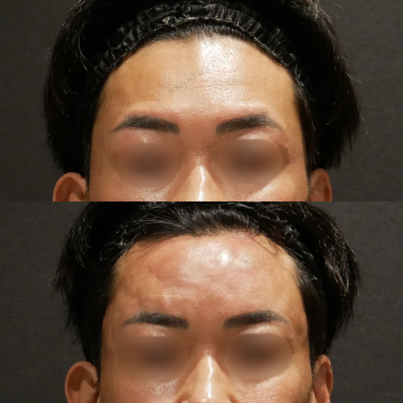 額ヒアルロン酸ボリューマ症例写真
