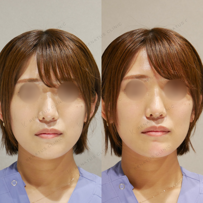 顎ヒアルロン酸ボラックス症例写真