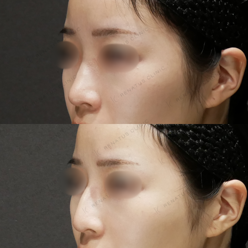 鼻ヒアルロン酸ボラックス症例写真