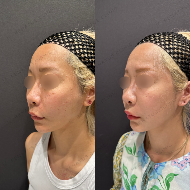 糸リフト・ヒアルロン酸（ほうれい線・頬）ボリフト症例写真
