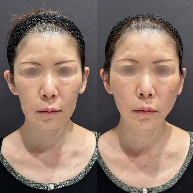 糸リフト・頬ボリフトヒアルロン酸症例写真