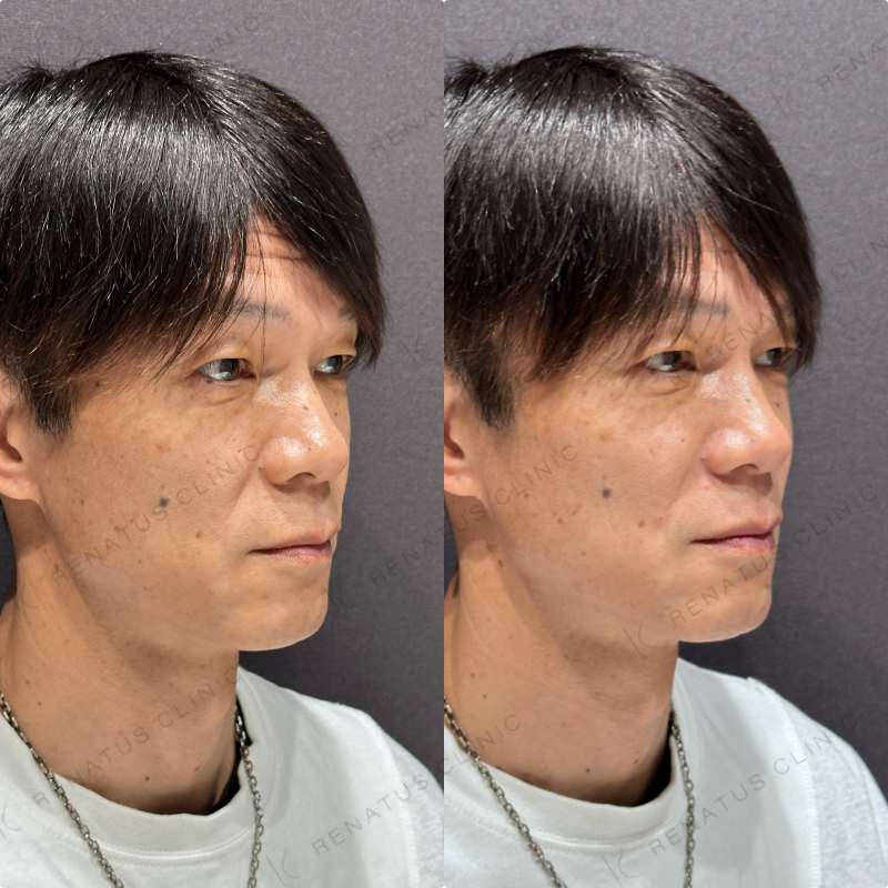 ほうれい線ヒアルロン酸ボリフト症例写真