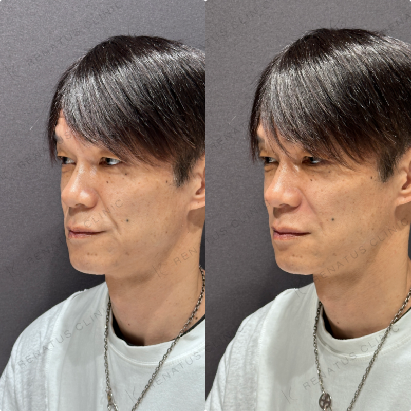 ほうれい線ヒアルロン酸ボリフト症例写真