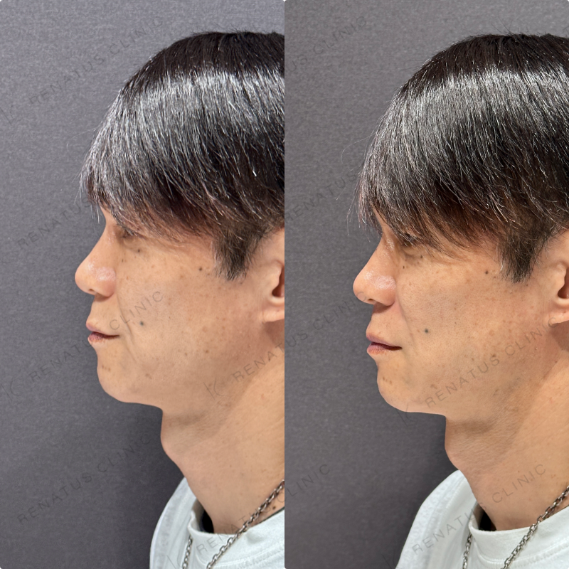 ほうれい線ヒアルロン酸ボリフト症例写真