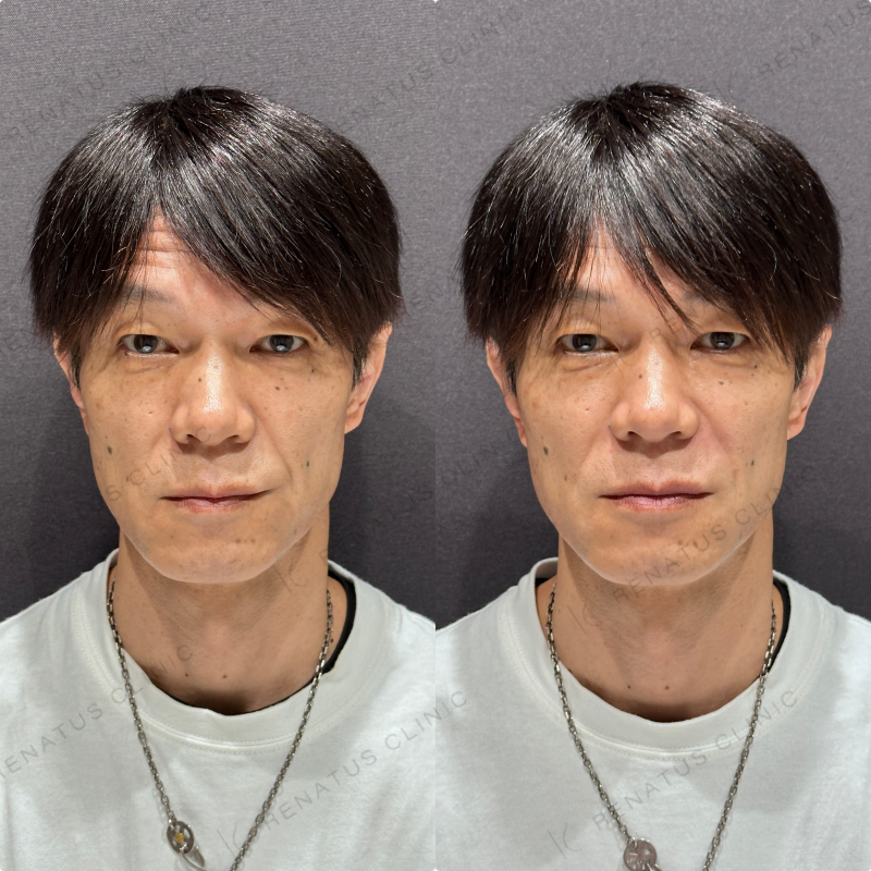 ほうれい線ヒアルロン酸ボリフト症例写真