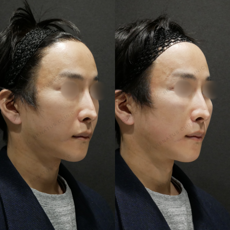 ゴルゴラインヒアルロン酸ボリューマ症例写真