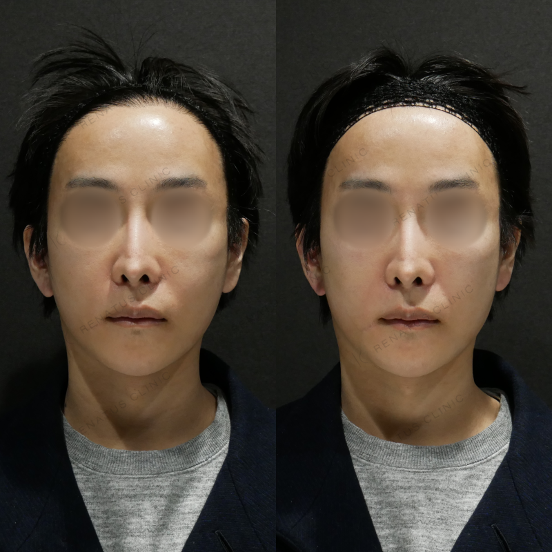 ゴルゴラインヒアルロン酸ボリューマ症例写真