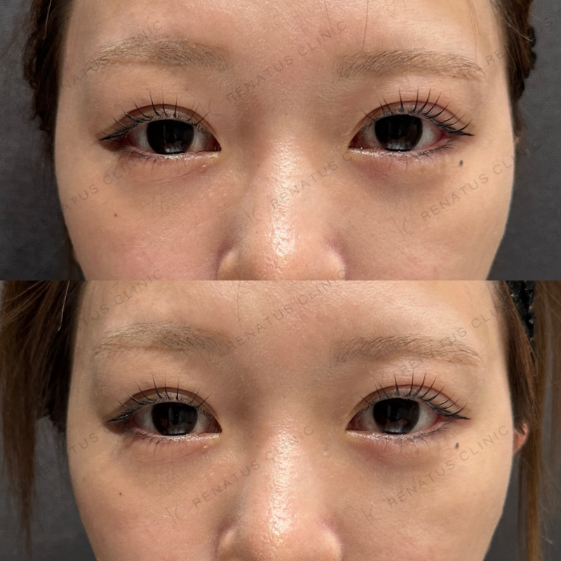 涙袋ヒアルロン酸ボルベラ症例写真