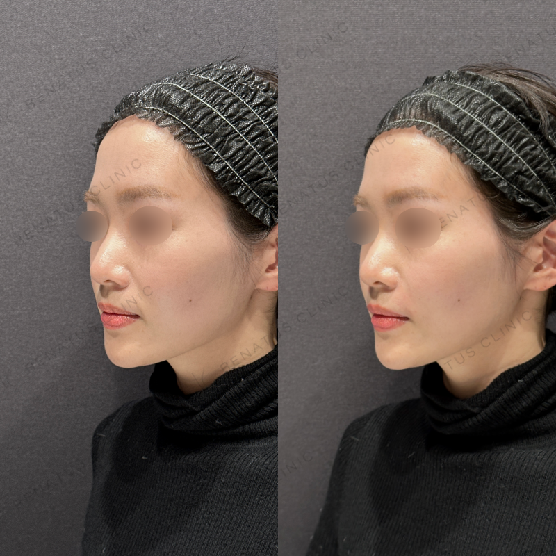 ほうれい線ヒアルロン酸ダイヤモンドフィール症例写真