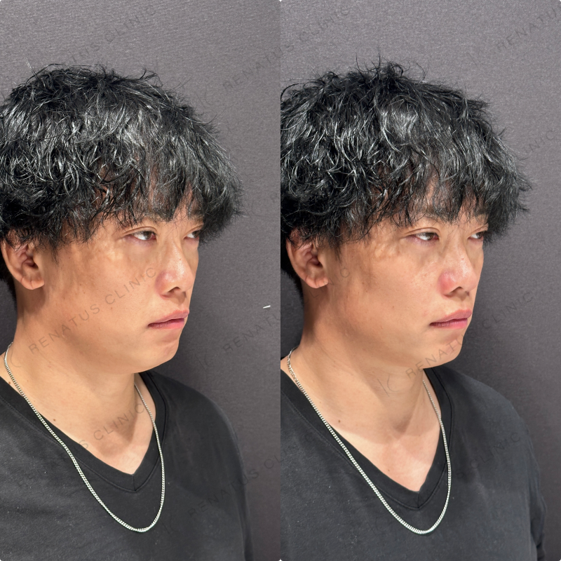 ほうれい線ヒアルロン酸ダイヤモンドフィール症例写真
