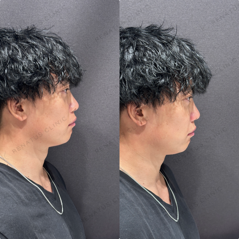 ほうれい線ヒアルロン酸ダイヤモンドフィール症例写真
