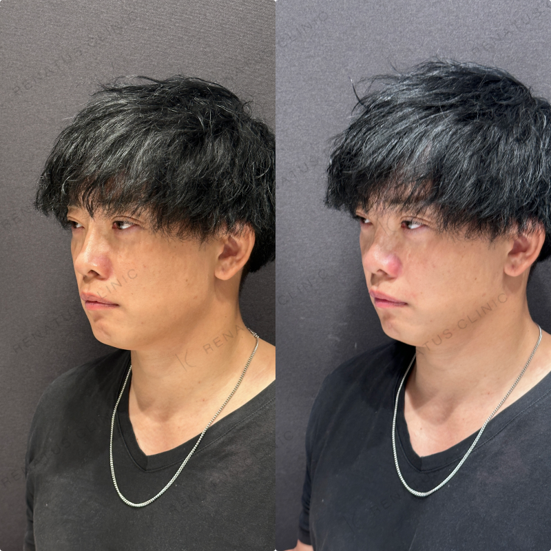 ほうれい線ヒアルロン酸ダイヤモンドフィール症例写真