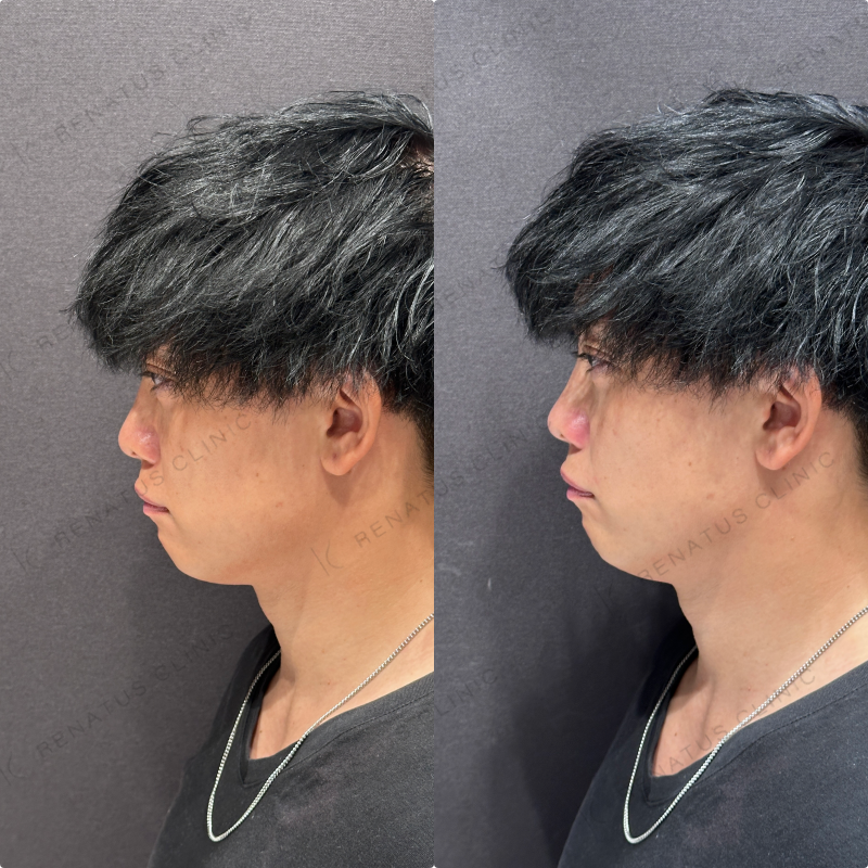 ほうれい線ヒアルロン酸ダイヤモンドフィール症例写真