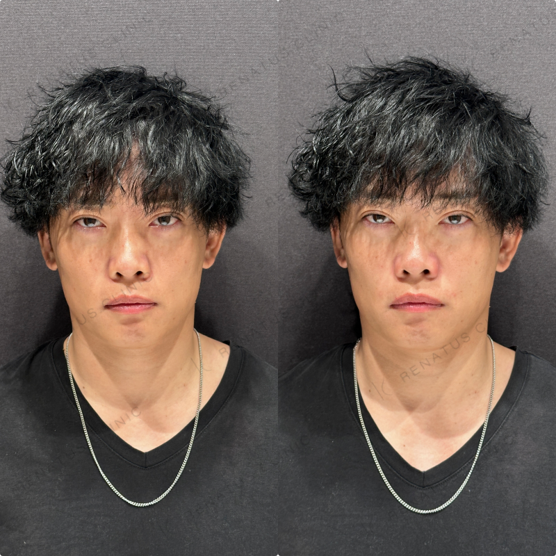 ほうれい線ヒアルロン酸ダイヤモンドフィール症例写真
