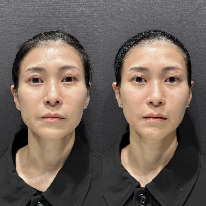 ほうれい線ヒアルロン酸ボライト・ボリフト症例写真