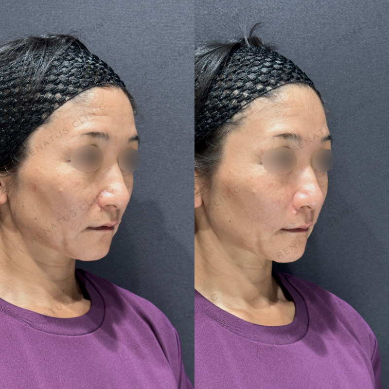 ほうれい線ヒアルロン酸ボリフト症例写真