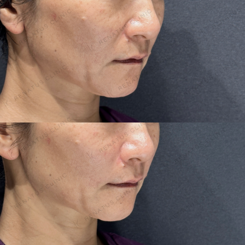 ほうれい線ヒアルロン酸ボリフト症例写真