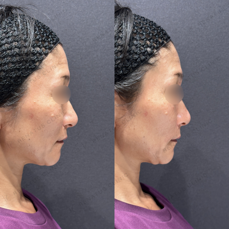 ほうれい線ヒアルロン酸ボリフト症例写真