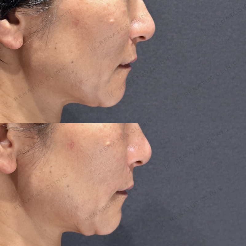 ほうれい線ヒアルロン酸ボリフト症例写真